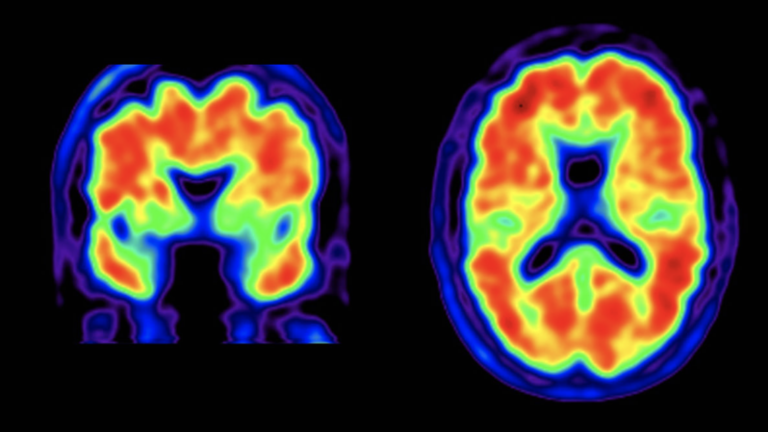 Tulane researcher asks, “Could chronic Lyme contribute to Alzheimer’s dementia?”